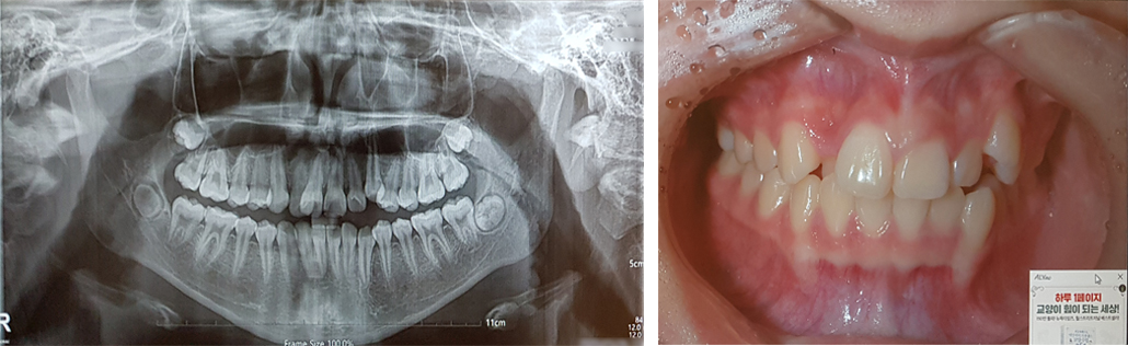 치아교정 전.jpg